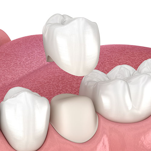 Crown replacement example