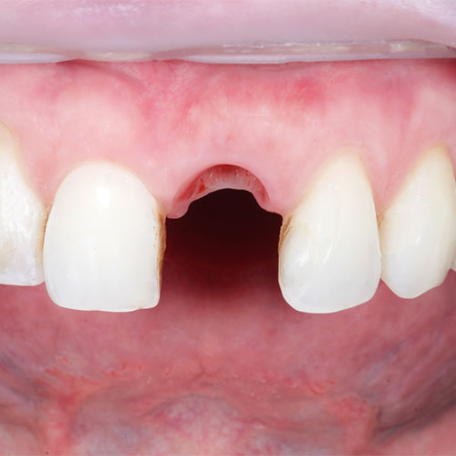 Missing tooth example